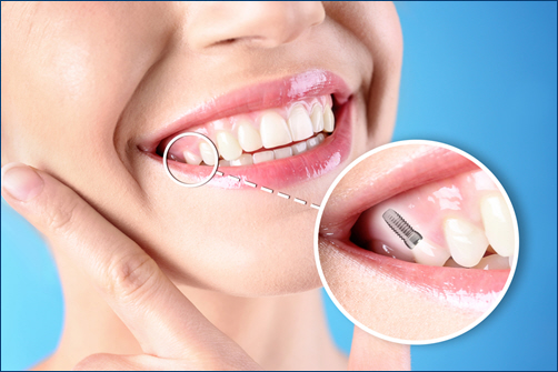 Dental Implants